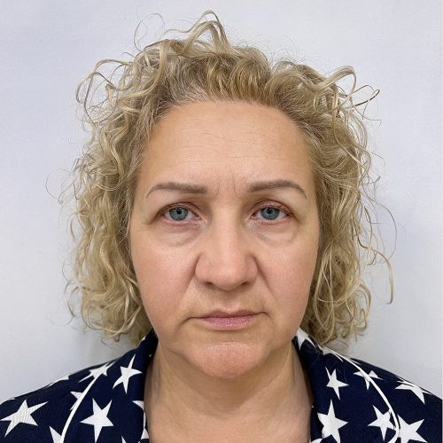miszczyk-policzek-3a-aspect-ratio-500-500
