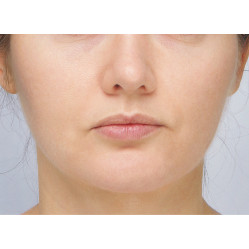 miszczyk-policzek-4a-aspect-ratio-500-500