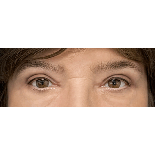 miszczyk-powieki-9b-aspect-ratio-500-500