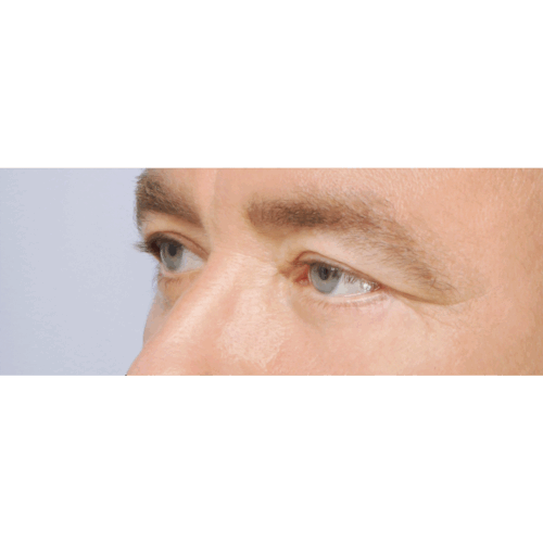 miszczyk-powieki-dolne-1d-aspect-ratio-500-500