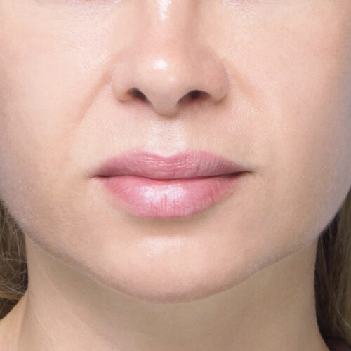 noname-endo-midface-id70513-5b-aspect-ratio-500-500