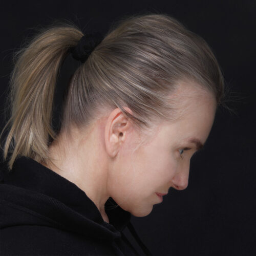 daria-dpfl–-30-dni-po-zabiegu-2id59916-15fjpg-1-aspect-ratio-500-500