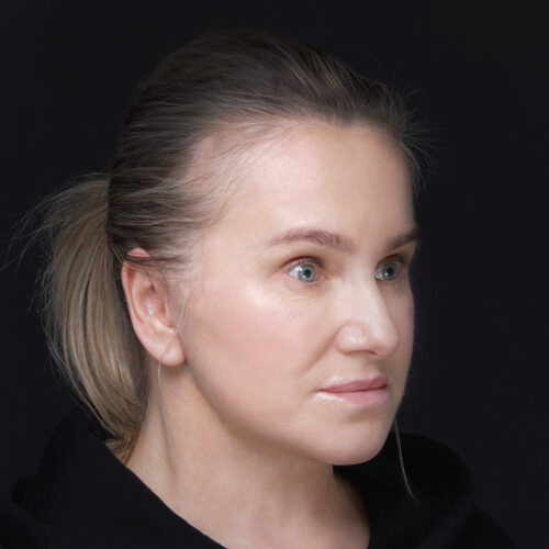 daria-dpfl–30-dni-po-zabiegu-1id59916-15d-aspect-ratio-500-500