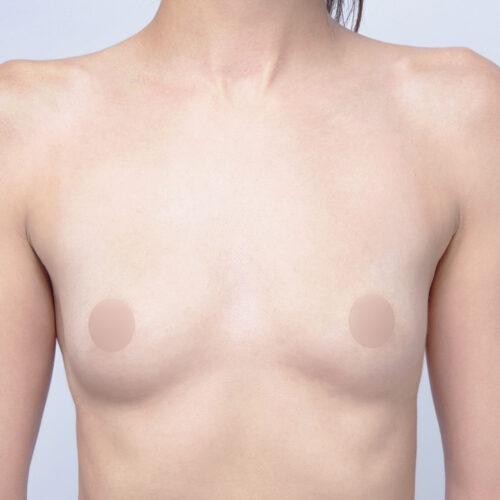 1-implanty-piersi-tpba-id62580-a-aspect-ratio-500-500