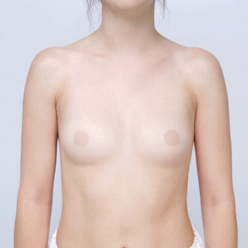 6c-implanty-piersi-tpba-id75570-c-aspect-ratio-500-500