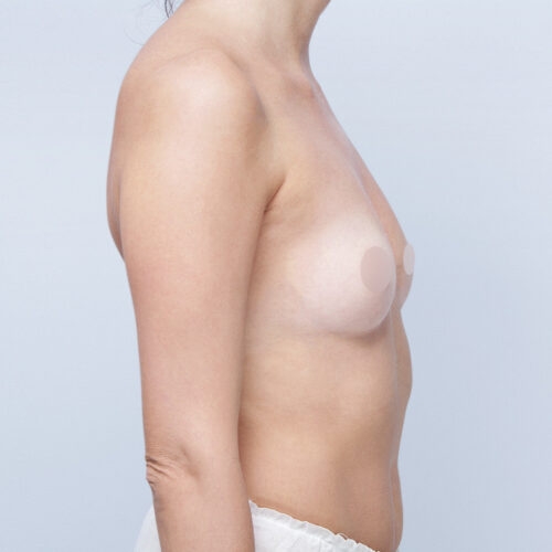 kulesza-implanty-piersi-id71894-10c-aspect-ratio-500-500