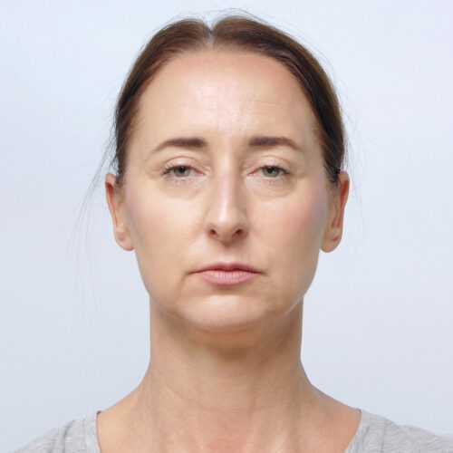 miszczyk-lifting-endoskopowy-brwi-midface-lifting-gleboki-szyi-lip-lift-id72530-8a-aspect-ratio-500-500