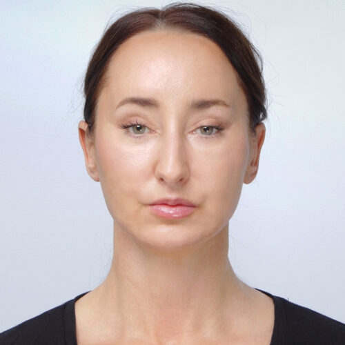 miszczyk-lifting-endoskopowy-brwi-midface-lifting-gleboki-szyi-lip-lift-id72530-8b-aspect-ratio-500-500