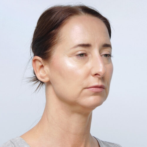 miszczyk-lifting-endoskopowy-brwi-midface-lifting-gleboki-szyi-lip-lift-id72530-8c-aspect-ratio-500-500