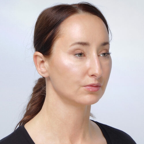 miszczyk-lifting-endoskopowy-brwi-midface-lifting-gleboki-szyi-lip-lift-id72530-8d-aspect-ratio-500-500