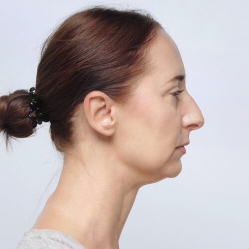 miszczyk-lifting-endoskopowy-brwi-midface-lifting-gleboki-szyi-lip-lift-id72530-8e-aspect-ratio-500-500