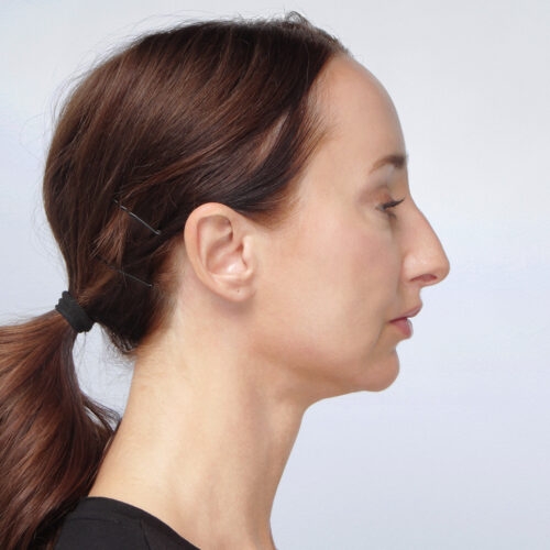miszczyk-lifting-endoskopowy-brwi-midface-lifting-gleboki-szyi-lip-lift-id72530-8f-aspect-ratio-500-500