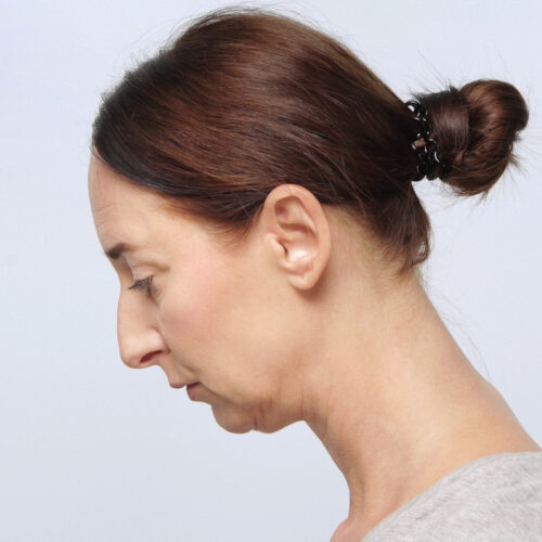 miszczyk-lifting-endoskopowy-brwi-midface-lifting-gleboki-szyi-lip-lift-id72530-8g-aspect-ratio-500-500