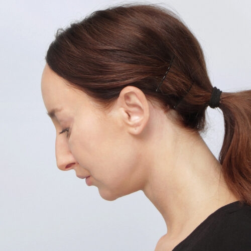 miszczyk-lifting-endoskopowy-brwi-midface-lifting-gleboki-szyi-lip-lift-id72530-8h-aspect-ratio-500-500
