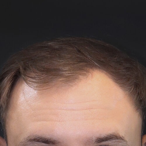 miszczyk-przeszczep-wlosow-id71132-35a-aspect-ratio-500-500