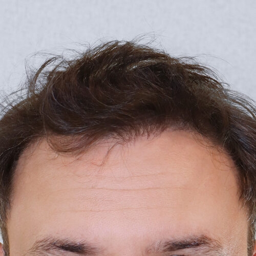 miszczyk-przeszczep-wlosow-id71132-35b-aspect-ratio-500-500