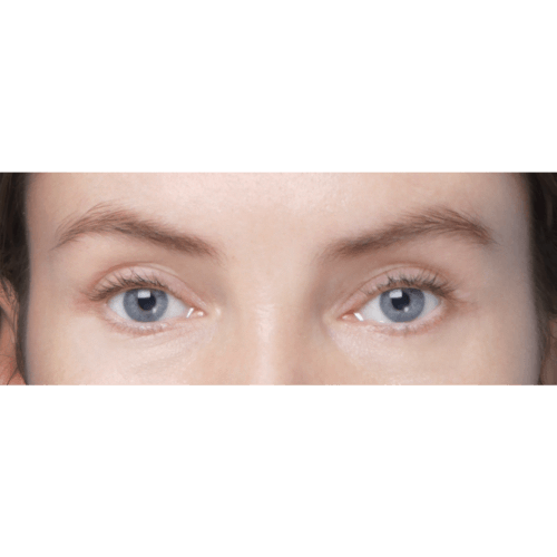 miszczyk-endoskopowy-lifting-brwi-liposukcja-chomikow-id73653-23b-aspect-ratio-500-500