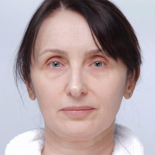 daria-plastyka-nosa-id73613-13a-aspect-ratio-500-500