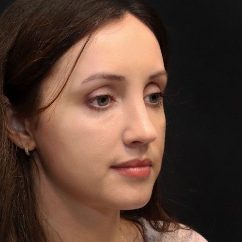 michal-korekcja-nosa-zgoda-42b-aspect-ratio-500-500