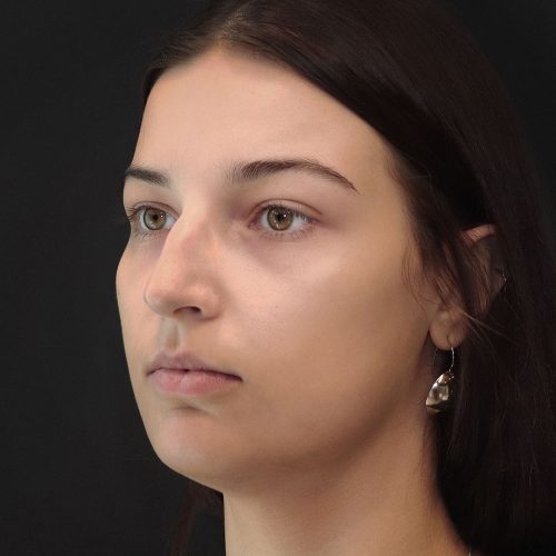 michal-korekcja-nosa-zgoda-43a-aspect-ratio-500-500