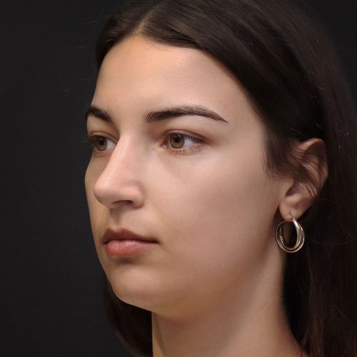 michal-korekcja-nosa-zgoda-43b-aspect-ratio-500-500