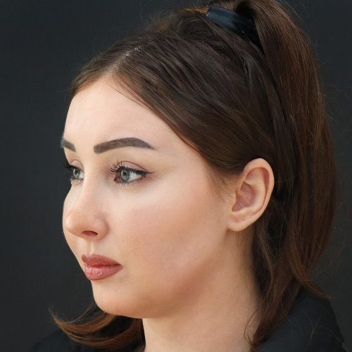 michal-plastyka-powiek-gornych-i-dolnych-id58523-zgoda-12b-aspect-ratio-500-500