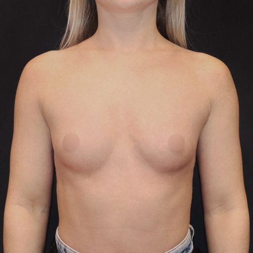 michal-powiekszenie-piersi-implantami-17a-aspect-ratio-500-500
