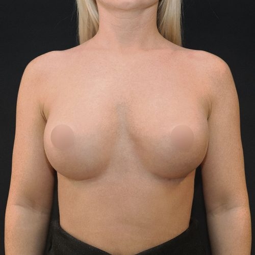 michal-powiekszenie-piersi-implantami-17b-aspect-ratio-500-500