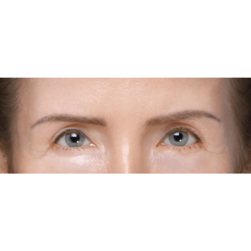 michal-endoskopowy-lifting-brwi-id61409-11a-aspect-ratio-500-500