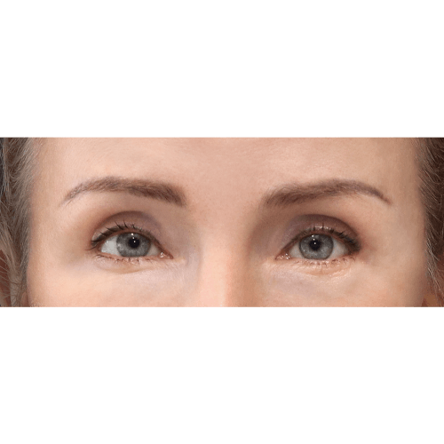 michal-endoskopowy-lifting-brwi-id61409-11b-aspect-ratio-500-500