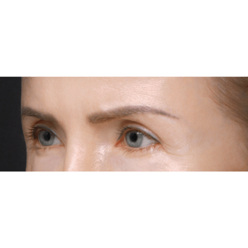 michal-endoskopowy-lifting-brwi-id61409-11c-aspect-ratio-500-500