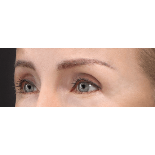 michal-endoskopowy-lifting-brwi-id61409-11d-aspect-ratio-500-500