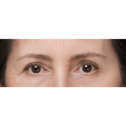 michal-lifting-brwi-id63199-9a-aspect-ratio-500-500