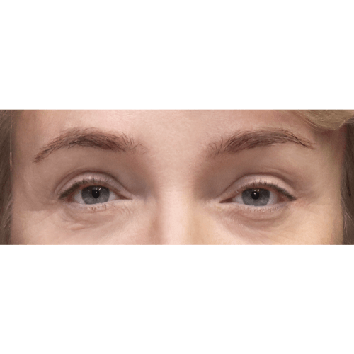michal-lifting-brwi-id71887-10b-aspect-ratio-500-500