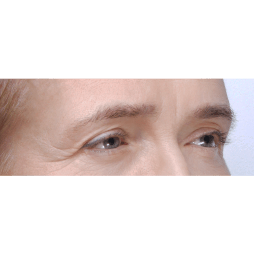 michal-lifting-brwi-id71887-10c-aspect-ratio-500-500