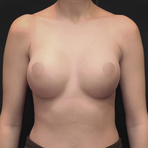 michal-powiekszenie-piersi-implantami-id61412-20b-aspect-ratio-500-500