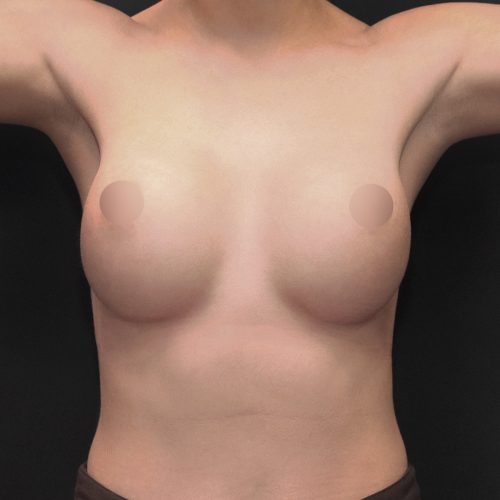 michal-powiekszenie-piersi-implantami-id61412-20d-aspect-ratio-500-500