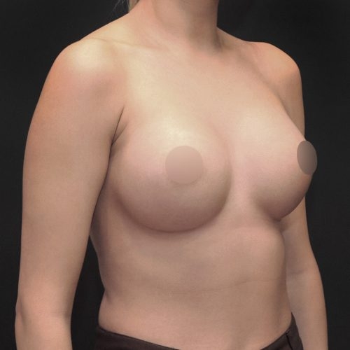 michal-powiekszenie-piersi-implantami-id61412-20f-aspect-ratio-500-500