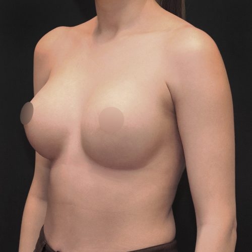 michal-powiekszenie-piersi-implantami-id61412-20h-aspect-ratio-500-500