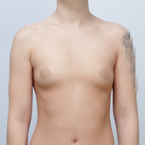 michal-powiekszenie-piersi-implantami-id63820-21a-aspect-ratio-500-500