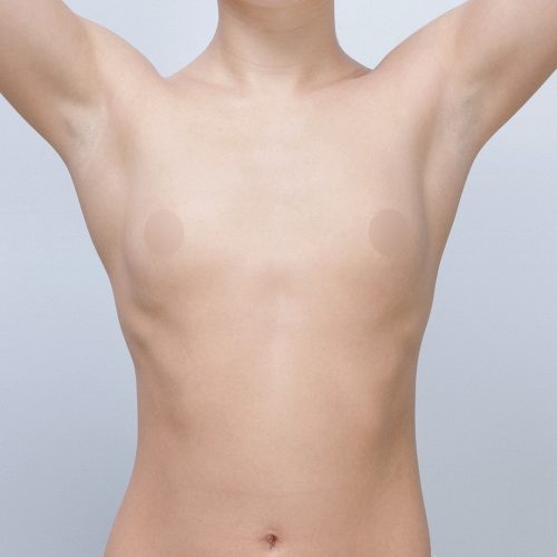 michal-powiekszenie-piersi-implantami-id63820-21c-aspect-ratio-500-500