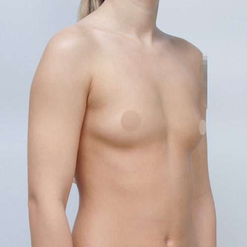 michal-powiekszenie-piersi-implantami-id63820-21e-aspect-ratio-500-500