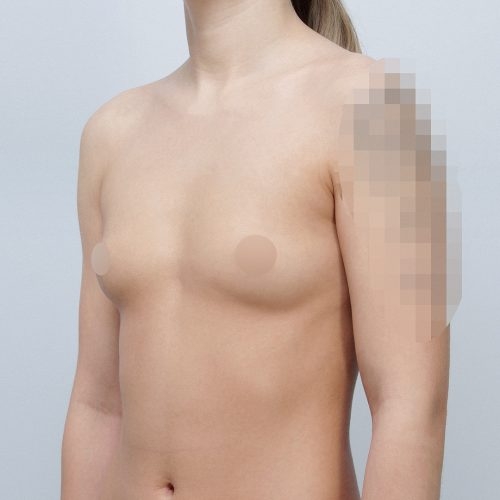 michal-powiekszenie-piersi-implantami-id63820-21g-aspect-ratio-500-500