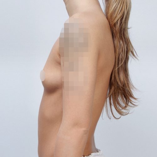michal-powiekszenie-piersi-implantami-id63820-21k-aspect-ratio-500-500