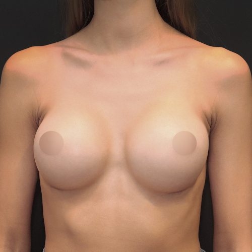 michal-powiekszenie-piersi-implantami-id67850-22b-aspect-ratio-500-500