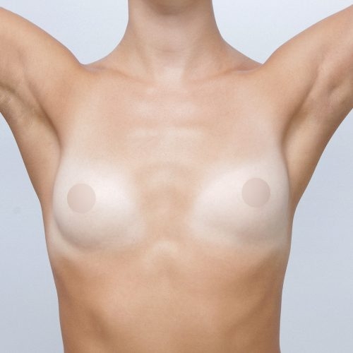 michal-powiekszenie-piersi-implantami-id67850-22c-aspect-ratio-500-500