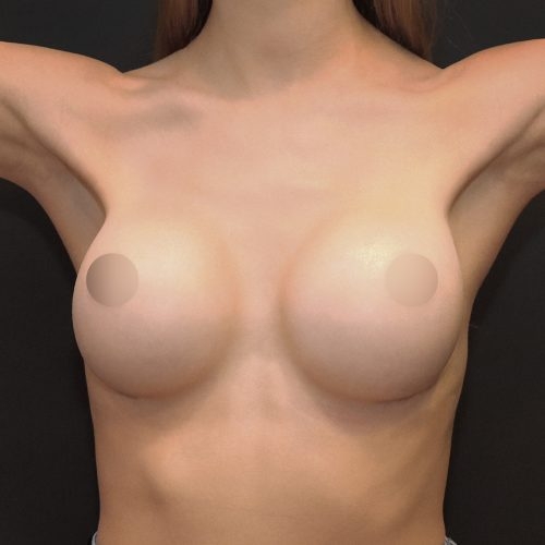 michal-powiekszenie-piersi-implantami-id67850-22d-aspect-ratio-500-500