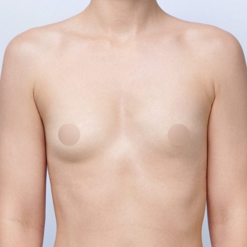 michal-powiekszenie-piersi-implantami-id70865-19a-aspect-ratio-500-500