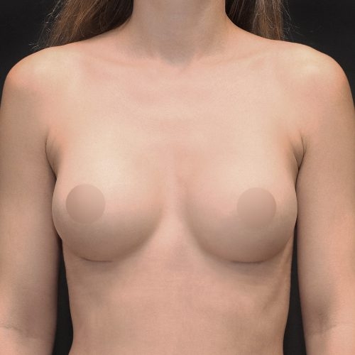 michal-powiekszenie-piersi-implantami-id70865-19b-aspect-ratio-500-500