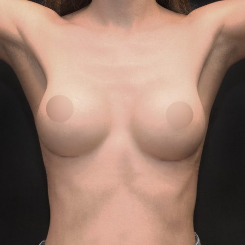 michal-powiekszenie-piersi-implantami-id70865-19d-aspect-ratio-500-500